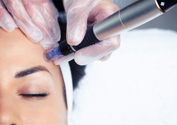 Close up of a radiofrequency microneedling pen being applied to a woman's forehead. Receive Morpheus8 Skin Rejuvenation treatment in Silver Spring.