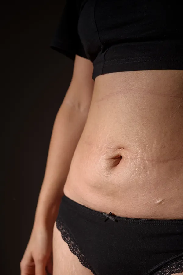 Close-up of stretch marks on a woman's waist. Get stretch mark removal treatment from Dr. Lashea Davis Roland in Silver Spring.