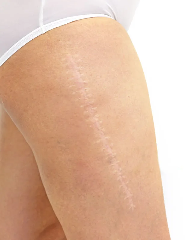 Close-up of a surgical scar running down a woman's thigh. Get surgical scar removial from Dr. Lashea Davis Roland in Silver Spring.